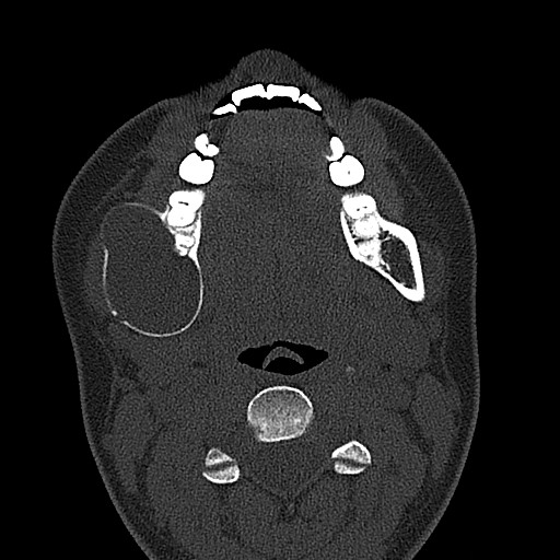 File:Ameloblastoma (Radiopaedia 26645-26793 E 37).jpg