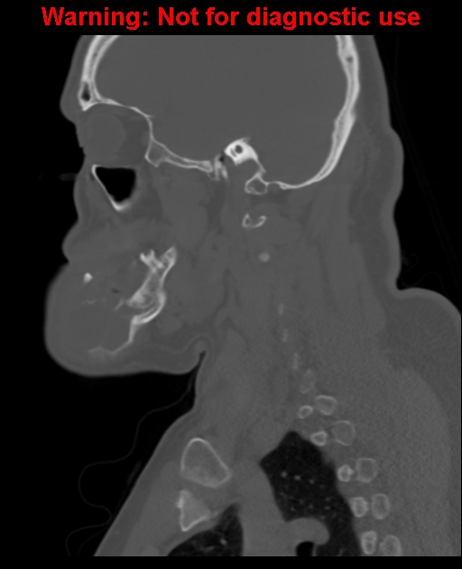 Ameloblastoma (Radiopaedia 33126-34164 Sagittal bone window 51).jpg