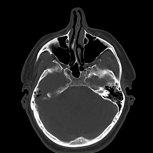 Ameloblastoma (Radiopaedia 38520-40623 Axial bone window 10).png