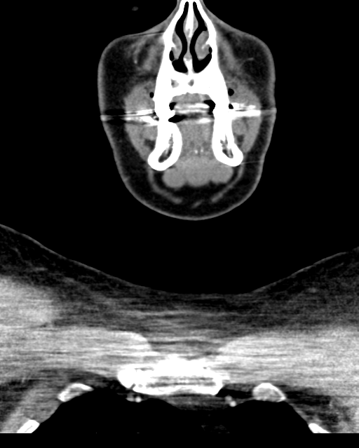 Ameloblastoma (Radiopaedia 38520-40623 Coronal non-contrast 18).png