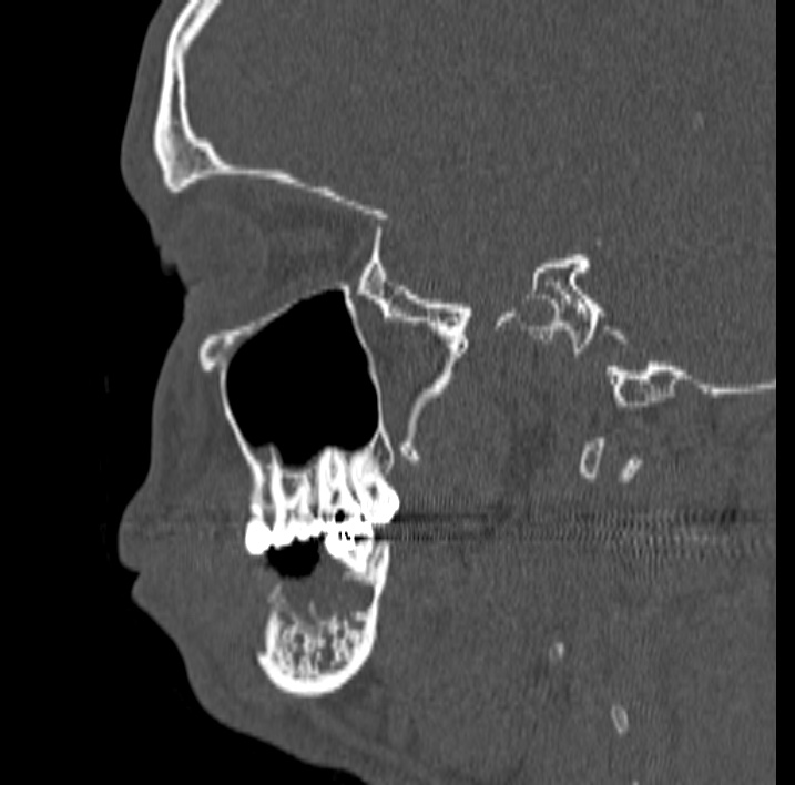 Ameloblastoma (Radiopaedia 77750-89997 Sagittal bone window 43).jpg