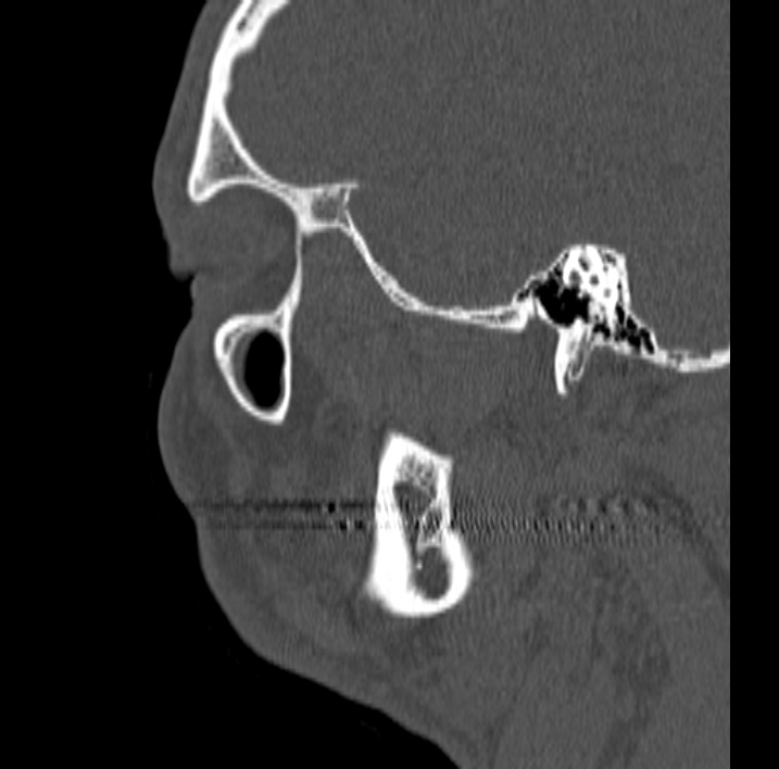 Ameloblastoma (Radiopaedia 77750-89997 Sagittal bone window 87).jpg