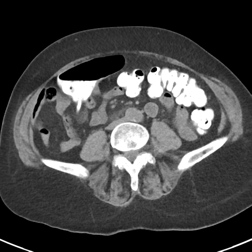 File:Ampullary adenocarcinoma (Radiopaedia 34013-35237 Axial non-contrast 37).png