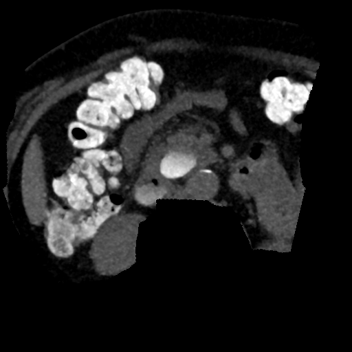 Ampullary adenocarcinoma (Radiopaedia 34013-35241 AXIAL MIPS 3-1.5 78).png