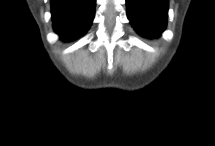Ampullary adenocarcinoma (Radiopaedia 34013-35241 Coronal 51).png