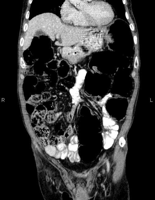 Ampullary adenocarcinoma (Radiopaedia 86093-102032 C 20).jpg