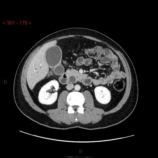 Ampullary carcinoma (Radiopaedia 56396-63056 C 47).jpg