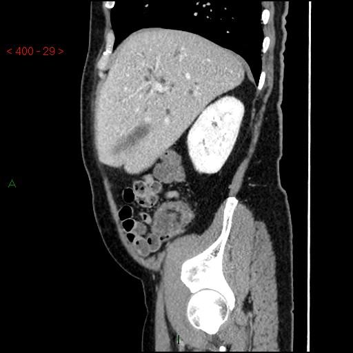 Ampullary carcinoma (Radiopaedia 56396-63056 D 28).jpg