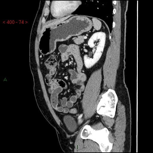 Ampullary carcinoma (Radiopaedia 56396-63056 D 73).jpg