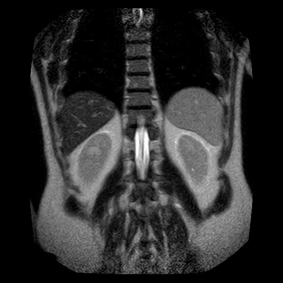 File:Ampullary tumor (Radiopaedia 27294-27479 Coronal T2 22).jpg