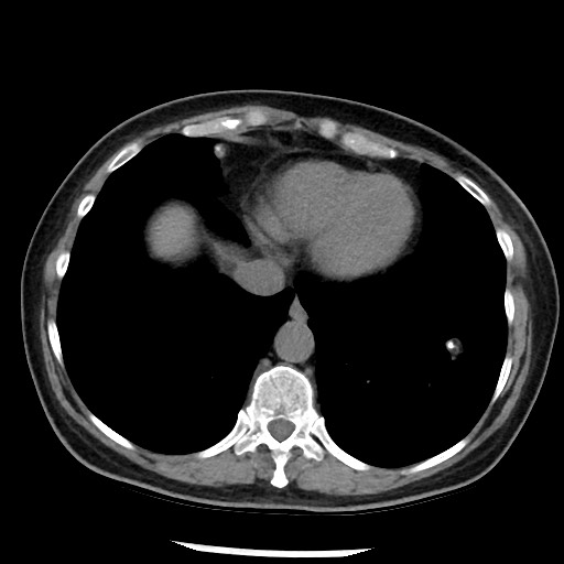 Amyloidosis - bronchial and diffuse nodular pulmonary involvement (Radiopaedia 60156-67744 Axial non-contrast 44).jpg