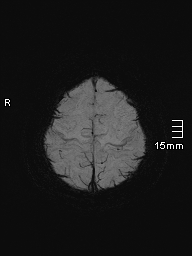 File:Amyotrophic lateral sclerosis (Radiopaedia 70821-81017 Axial SWI minIP 44).jpg