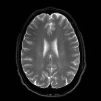 Amyotrophic lateral sclerosis (Radiopaedia 87352-103658 Axial DWI 18).jpg