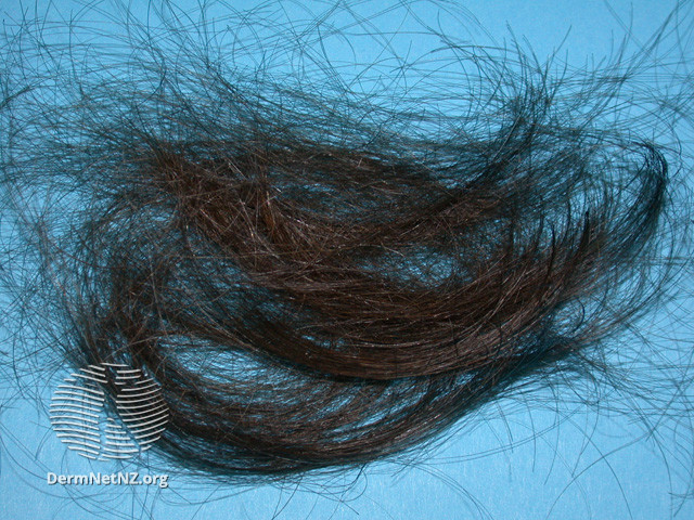 File:Anagen effluvium- hair pull (DermNet NZ hair-nails-sweat-anagen-effluvium-10).jpg