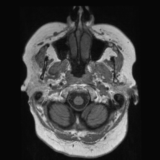 File:Anaplastic astrocytoma IDH wild-type (pseudoprogression) (Radiopaedia 42209-45278 Axial T1 23).png