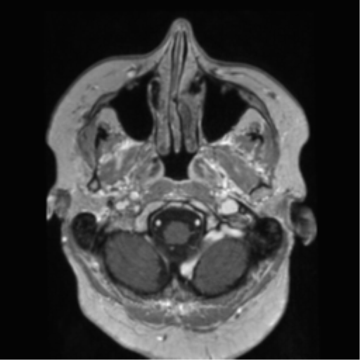 File:Anaplastic astrocytoma IDH wild-type (pseudoprogression) (Radiopaedia 42209-45278 Axial T1 C+ 28).png