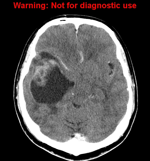 File:Anaplastic ganglioglioma (Radiopaedia 44921-48815 B 12).jpg