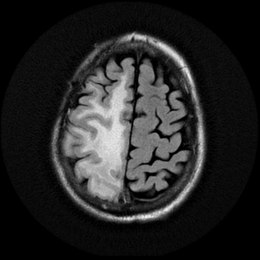 File:Anaplastic meningioma with recurrence (Radiopaedia 34452-35790 Axial T2 FLAIR 18).png