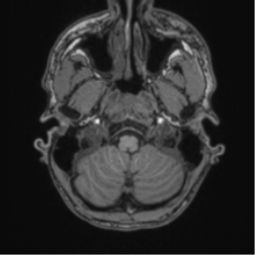 Anaplastic oligodendroglioma with skull fracture (Radiopaedia 74831-85845 Axial T1 3).png