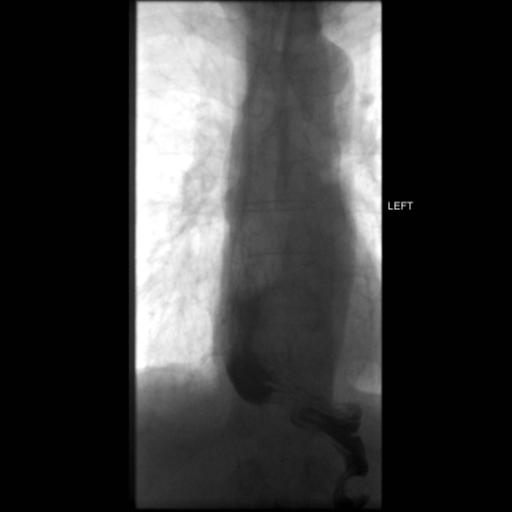 File:Anastomotic stricture post Ivor Lewis esophagectomy (Radiopaedia 47937-52715 C 5).png