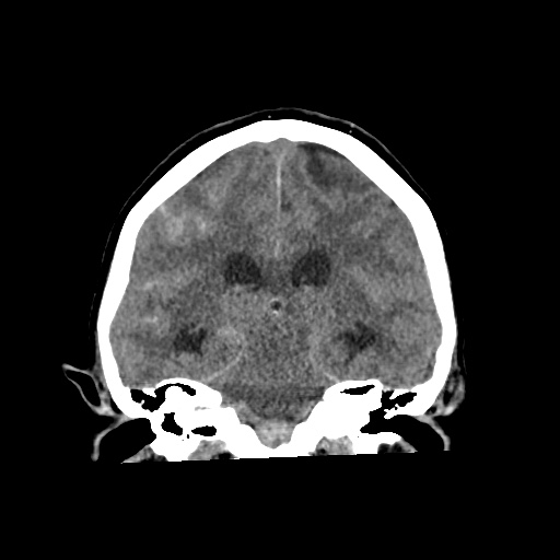 Aneursym related subarachnoid hemorrhage with hydrocephalus (Radiopaedia 45105-49083 Coronal non-contrast 39).jpg
