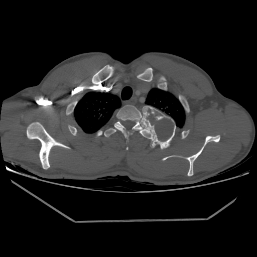 File:Aneurysmal bone cyst - rib (Radiopaedia 82167-96220 Axial bone window 62).jpg