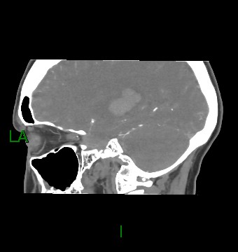Aneurysmal subarachnoid hemorrhage with intra-axial extension (Radiopaedia 84371-99732 B 44).jpg