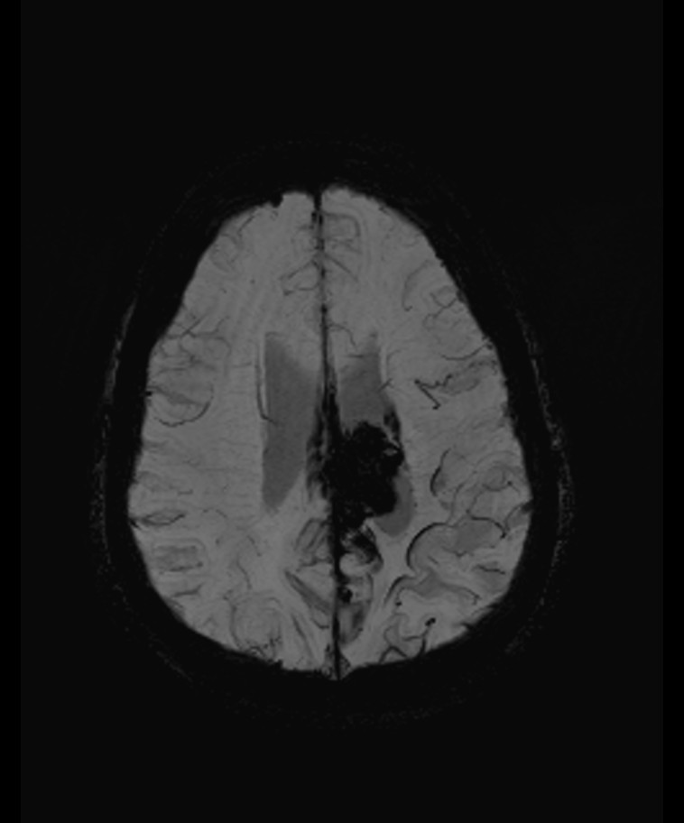Angiomatous meningioma (Radiopaedia 79459-92579 E 47).jpg
