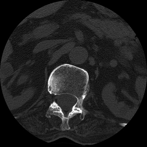 Ankylosing spondylitis complicated by fracture-dislocation (Radiopaedia 33583-34674 Axial non-contrast 9).jpg