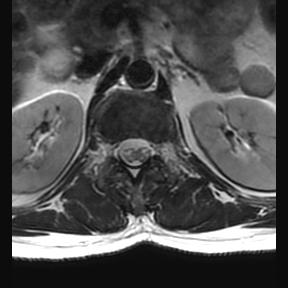 File:Ankylosing spondylitis with zygapophyseal arthritis (Radiopaedia 38433-40516 Axial T2 21).jpg