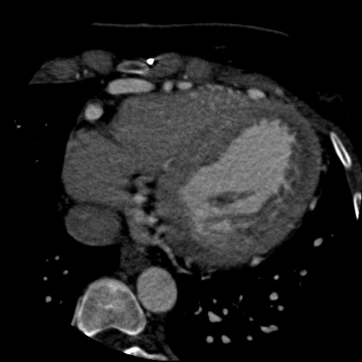 File:Anomalous left coronary artery from the pulmonary artery (ALCAPA) (Radiopaedia 40884-43586 A 62).jpg