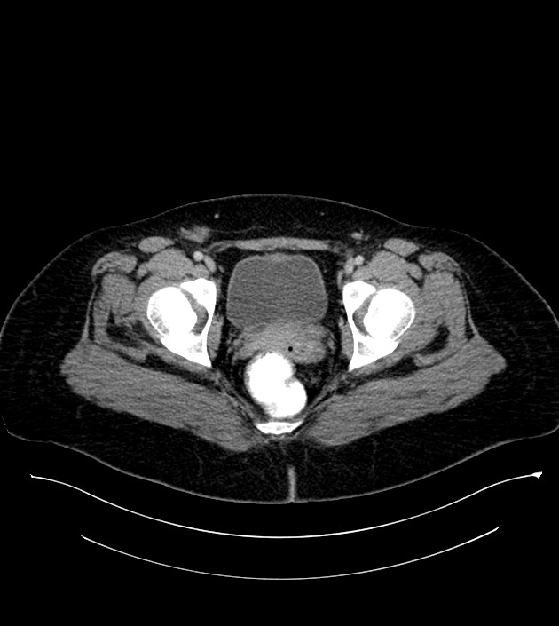 Anterior abdominal wall CSF pseudocyst (CSFoma) (Radiopaedia 79453-92571 A 86).jpg