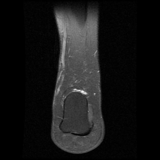 File:Anterior calcaneal process fracture (Radiopaedia 71377-81705 Coronal PD fat sat 15).jpg