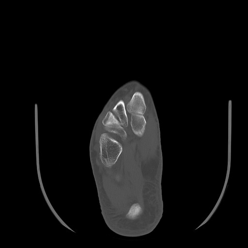 Anterior calcaneal process fracture (Radiopaedia 82590-96762 Axial bone window 30).jpg