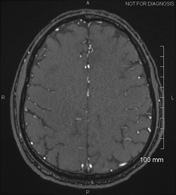 Anterior cerebral artery aneurysm (Radiopaedia 80683-94127 Axial MRA 180).jpg