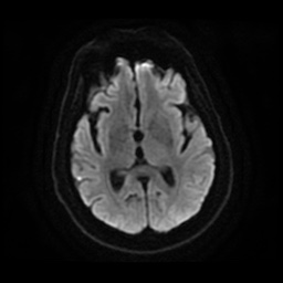 Anterior cerebral artery infarction (Radiopaedia 46794-51323 Axial DWI 15).jpg
