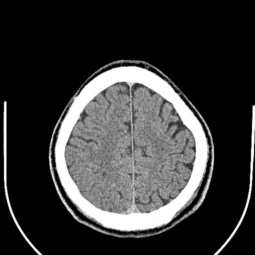 Anterior choroidal artery infarct (Radiopaedia 55106-61480 Axial non-contrast 48).jpg