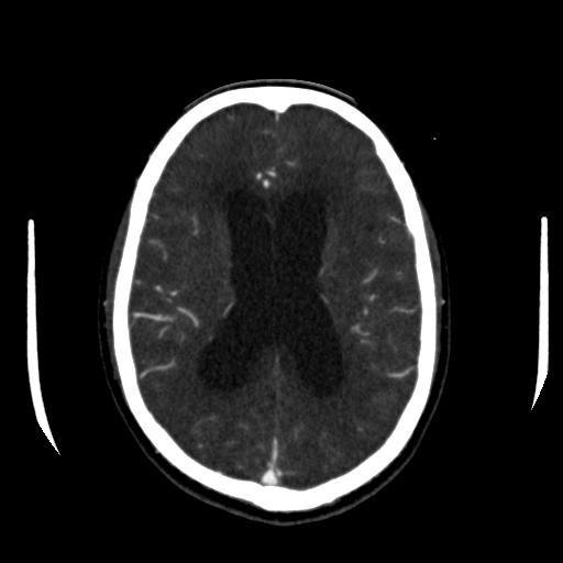 File:Anterior communicating artery aneurysm (Radiopaedia 16633-16335 A 27).jpg