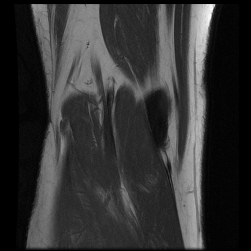 File:Anterior cruciate ligament avulsion fracture (Radiopaedia 58939-66193 Coronal T1 17).jpg