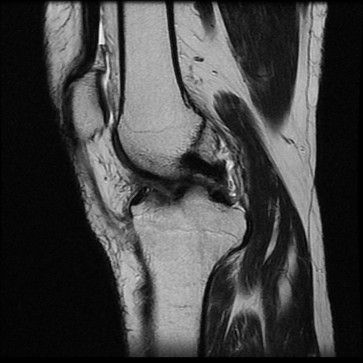 File:Anterior cruciate ligament avulsion fracture (Radiopaedia 58939-66193 Sagittal T2 13).jpg