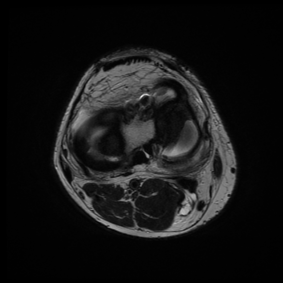 File:Anterior cruciate ligament graft tear and bucket-handle tear of medial meniscus (Radiopaedia 75867-87255 Axial T2 8).jpg