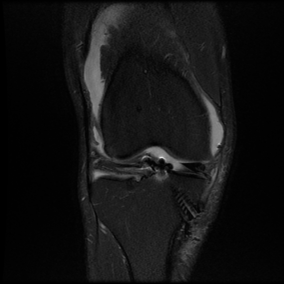 File:Anterior cruciate ligament graft tear and bucket-handle tear of medial meniscus (Radiopaedia 75867-87255 Coronal PD fat sat 10).jpg
