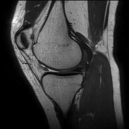 Anterior cruciate ligament rupture and posteromedial corner injury (Radiopaedia 67338-76723 Sagittal PD 61).jpg