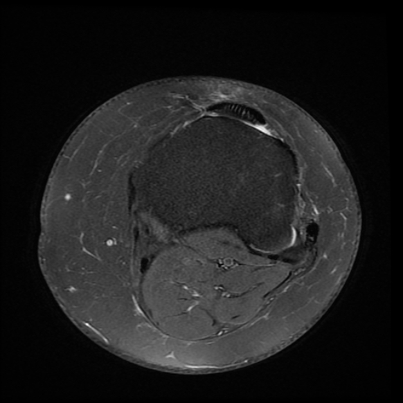 File:Anterior cruciate ligament tear, Wrisberg rip and bucket-handle tear of medial meniscus (Radiopaedia 75872-87266 Axial PD fat sat 4).jpg