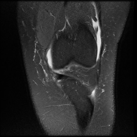 File:Anterior cruciate ligament tear, Wrisberg rip and bucket-handle tear of medial meniscus (Radiopaedia 75872-87266 Coronal PD fat sat 9).jpg