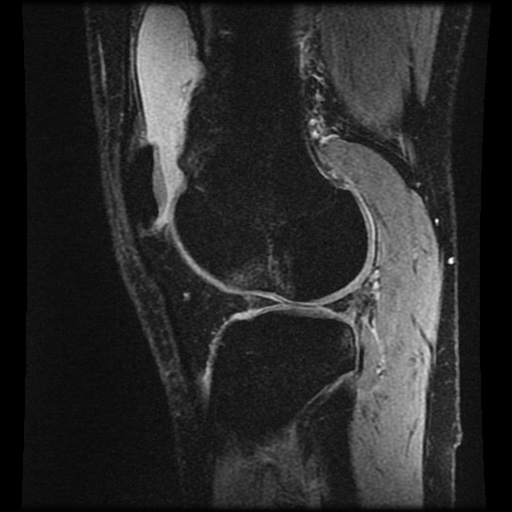 Anterior cruciate ligament tear (Radiopaedia 61500-69462 F 68).jpg