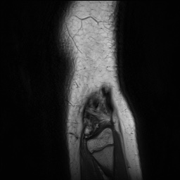 Anterior cruciate ligament tear - pediatric (Radiopaedia 62152-70260 Sagittal PD 162).jpg