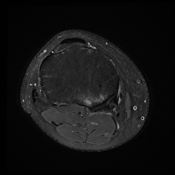 File:Anterior cruciate ligament tear with posteromedial corner injury, bucket-handle meniscal tear and chondral delamination (Radiopaedia 75501-86744 Axial PD fat sat 4).jpg