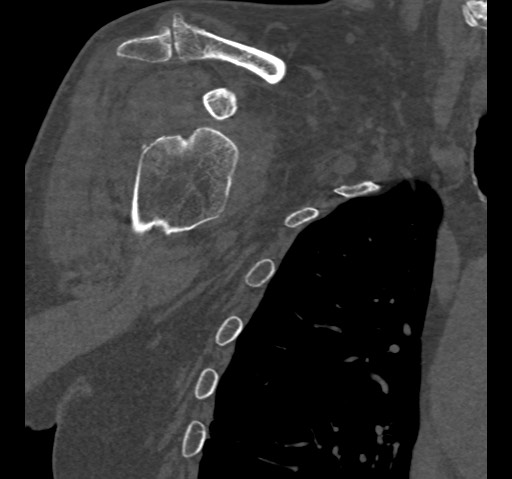Anterior glenohumeral dislocation with Hill-Sachs lesion (Radiopaedia 62877-71249 Coronal bone window 29).jpg