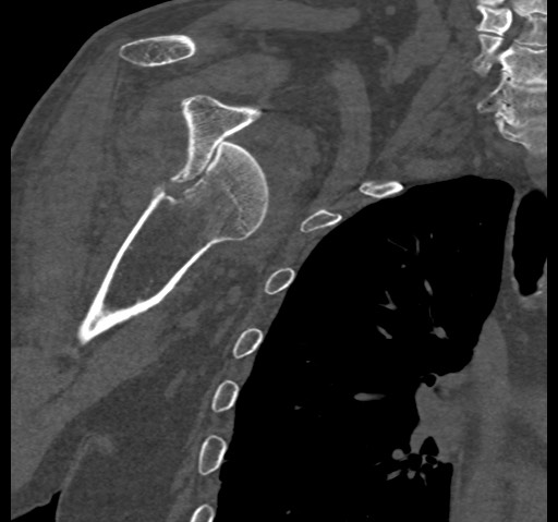 Anterior glenohumeral dislocation with Hill-Sachs lesion (Radiopaedia 62877-71249 Coronal bone window 48).jpg